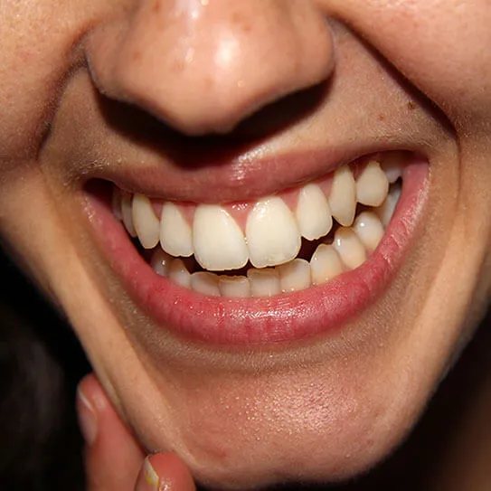 white spots teeth closeup