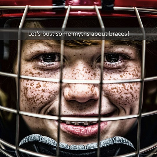 braces-myths