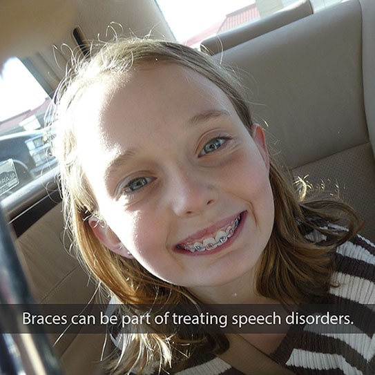 braces-speech