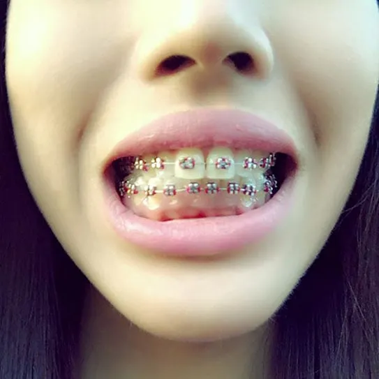 teeth braces
