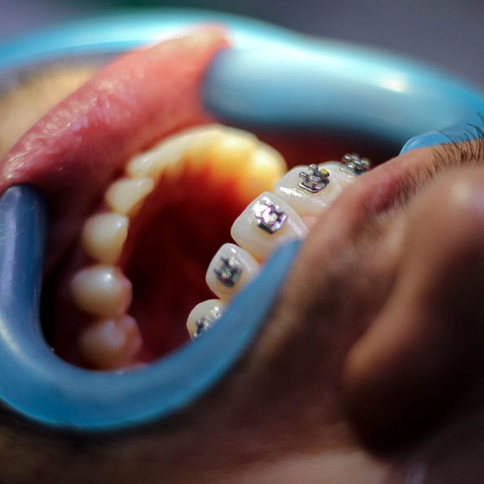 Teeth bracing close up