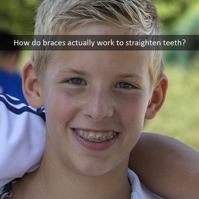 how-braces-work