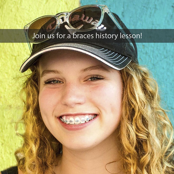 braces-history